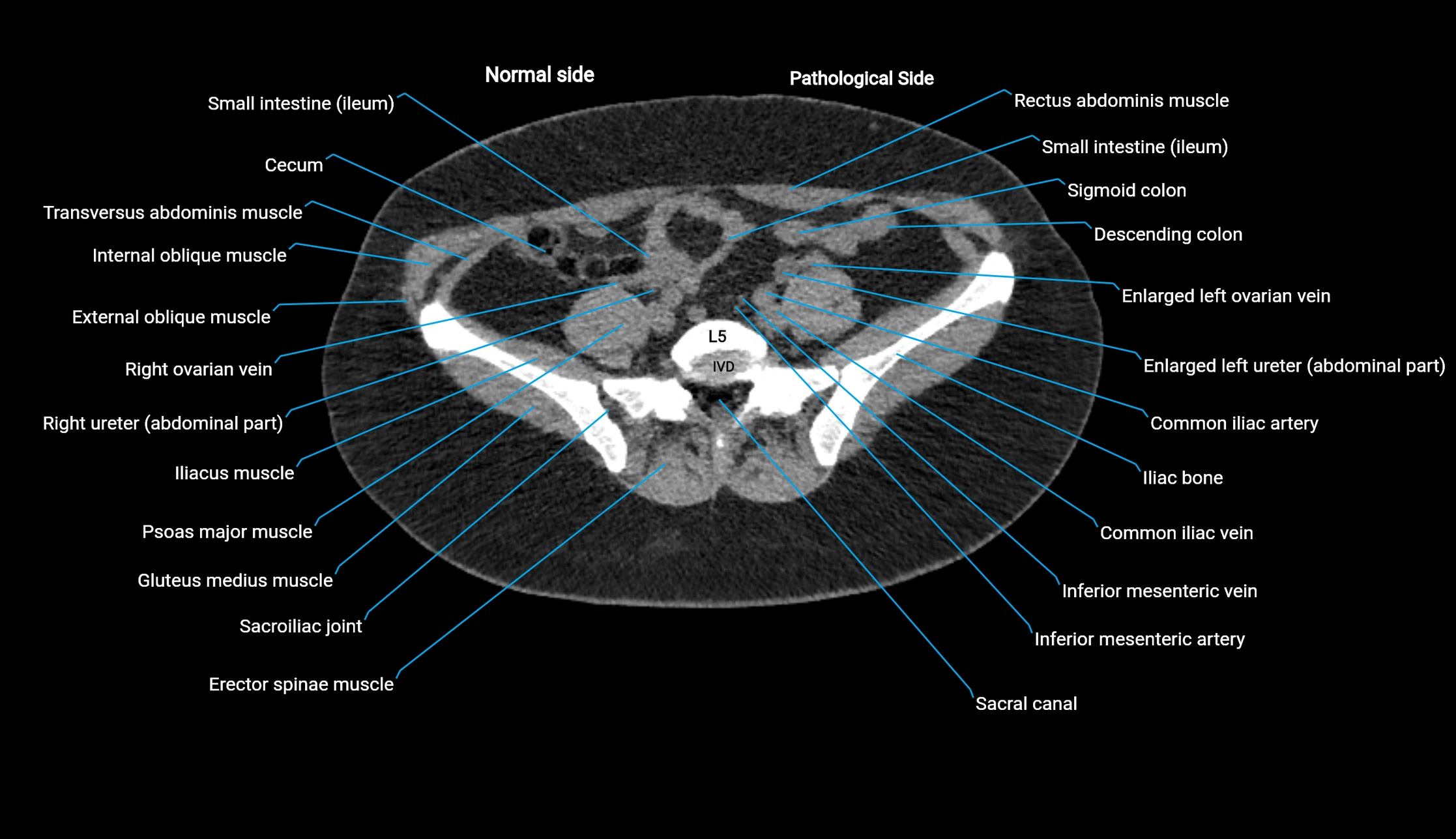 CT KUB axial cross sectional anatomy  radiology image -img-00201-00109.webp